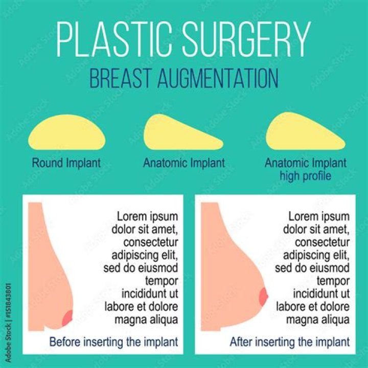 Breast Augmentation Before And After Celebrity Edition &mdash; Atlantic Health Solutions