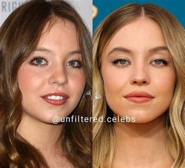 Sydney Sweeney Plastic Surgery Before and After. Nose Job, Facelift