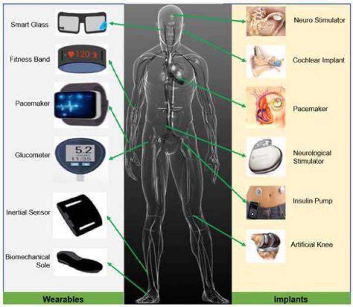 Understanding Sha Carri Implants: A Comprehensive Guide